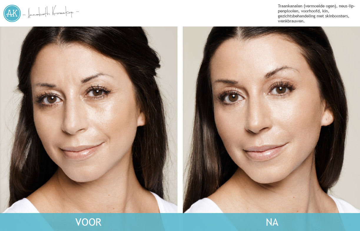 Arzu-voor-na-cosmetische-behandeling