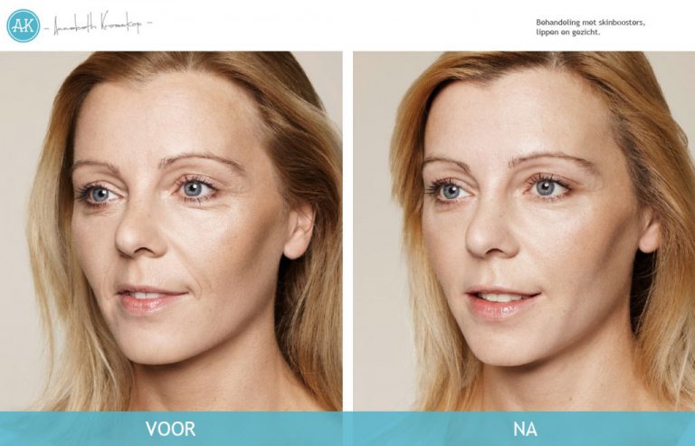 Christina-Voor-en-Na-Cosmetische-behandeling-768x493