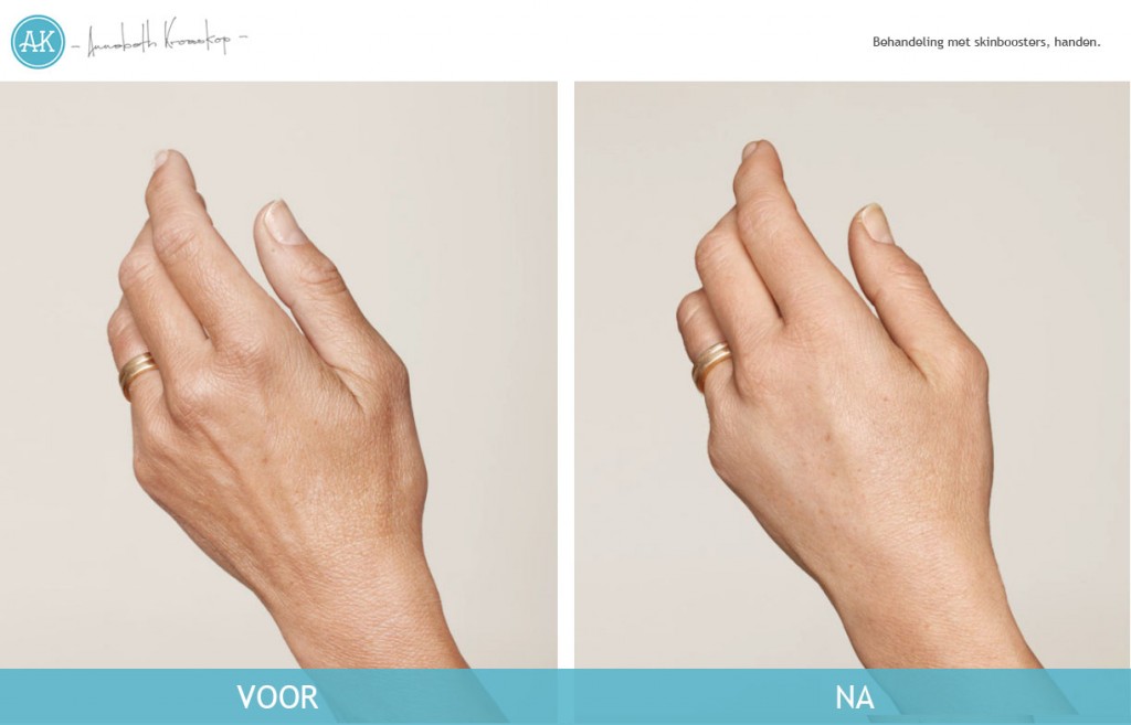 Handen-Camilla-Voor-Na-Cosmetische-behandeling