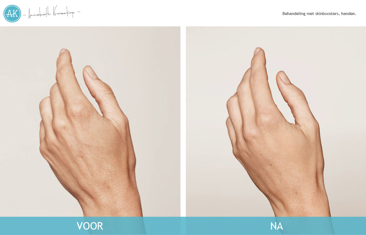 Handen-Maya-Voor-na-cosmetische-behandeling