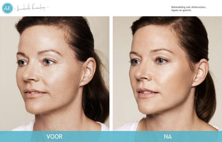 Maya-Voor-Na-Cosmetische-behandeling-768x493