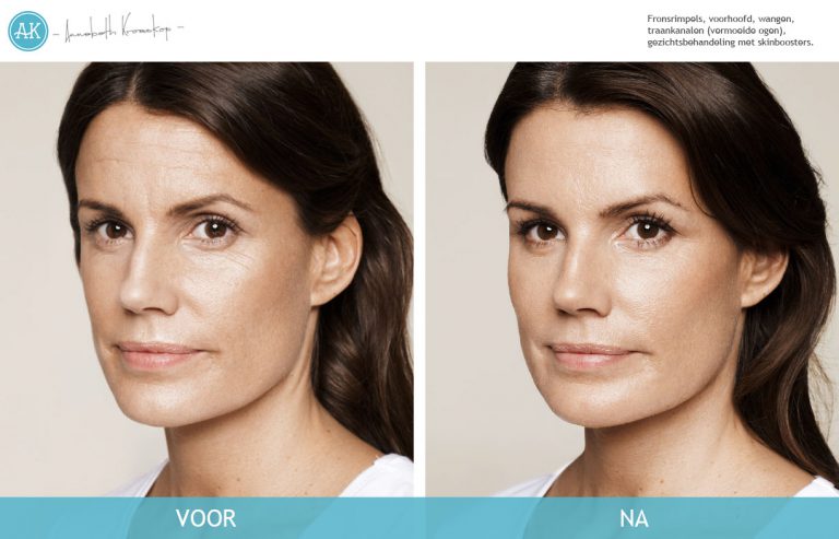 Pia-Voor-Na-Cosmetische-behandeling-768x493