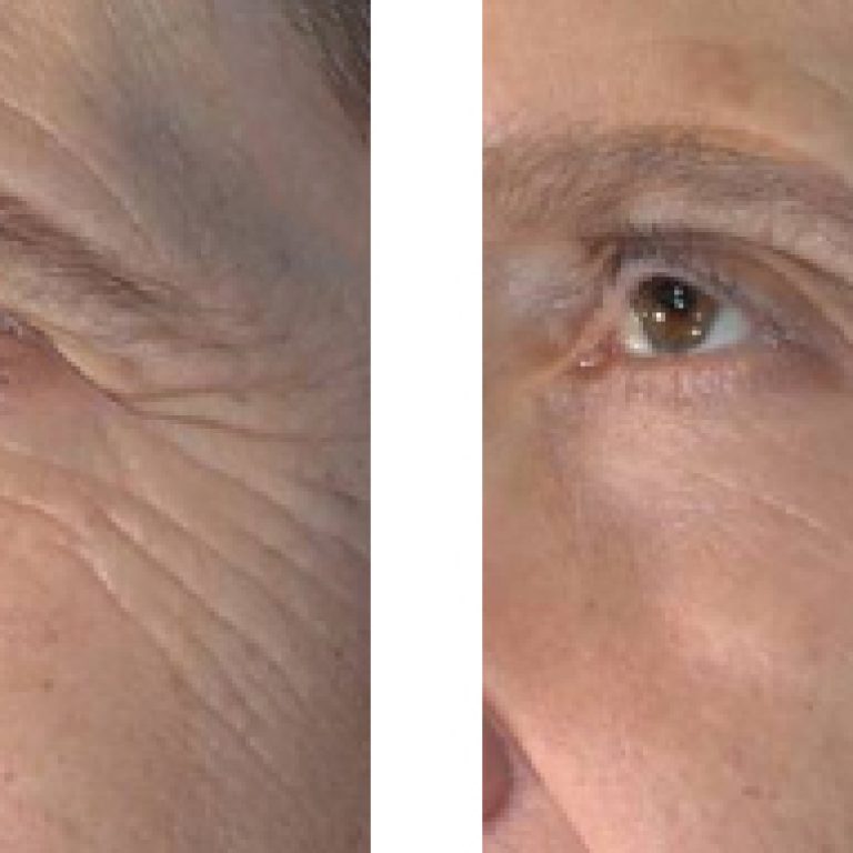 Patient-2-BA-325x191