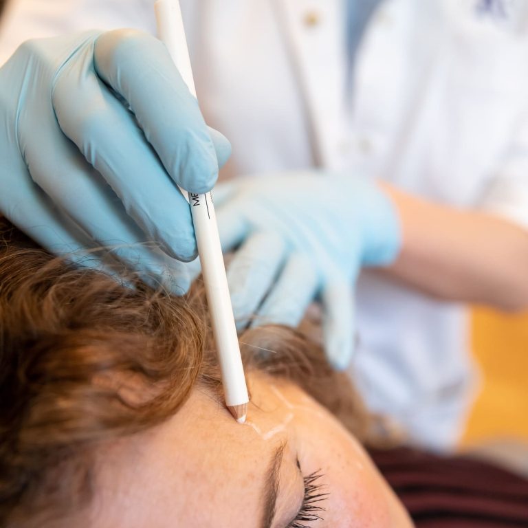 Tekenen_huidverjonging (1)