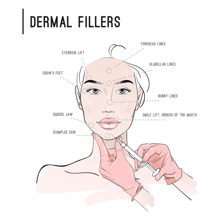 fillers-annebeth1